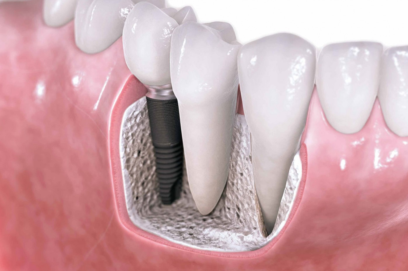 Chirurgia orale e Implantologia